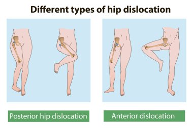 hip dislocation clipart