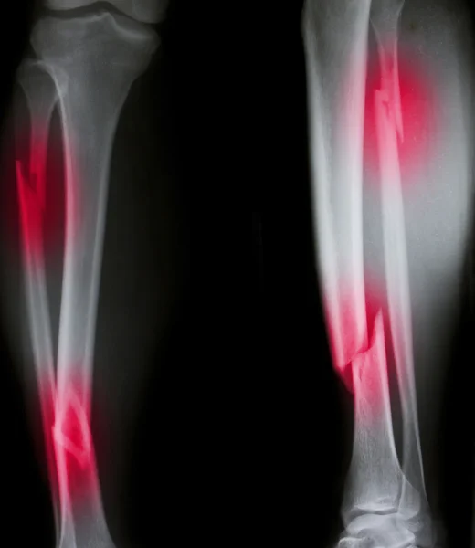 Röntgen beider menschlicher Beine (gebrochene Beine)) — Stockfoto