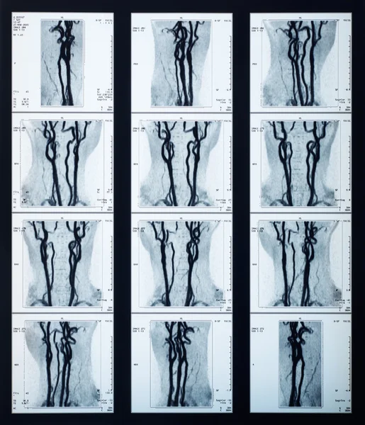 Radiografia das veias de raios X — Fotografia de Stock