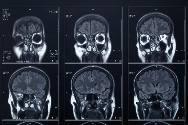 X-ray head and brain radiography — Stock Photo, Image