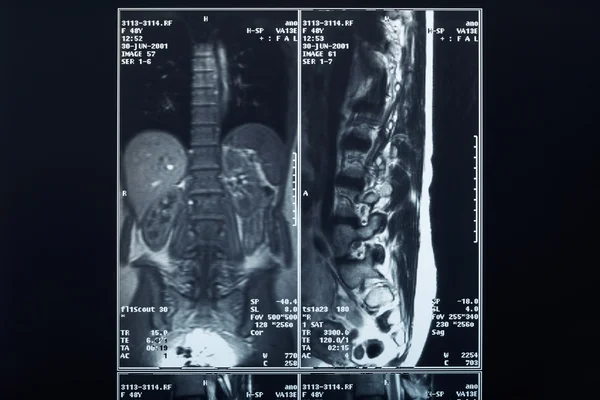 Prześwietlenie radiografia kręgosłupa — Zdjęcie stockowe