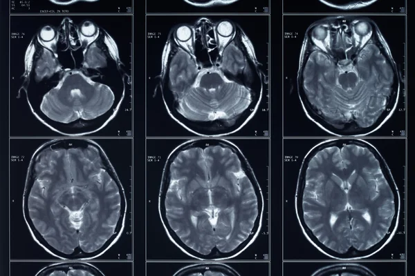 X 射线头部和大脑成像 — 图库照片