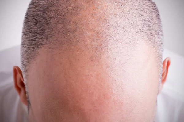 Hair Loss — Stock Photo, Image