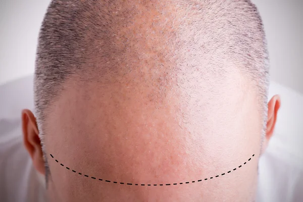 Hair Loss — Stock Photo, Image