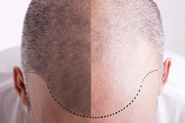 Pérdida de cabello - Antes y Después Imagen de stock