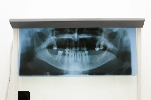 Xray zachycuje zuby — Stock fotografie