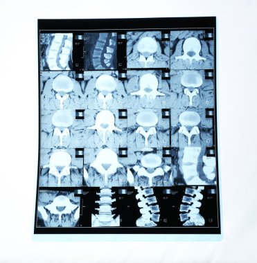 Kolaj üzerinde izole beyaz x-ışınları