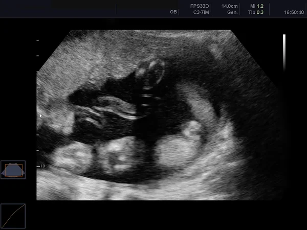 Ультразвуковое сканирование ребенка — стоковое фото