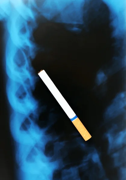 Cigarette on x-ray lung — Stock Photo, Image