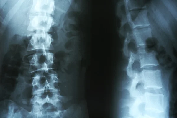Radiografía Primer Plano Columna Vertebral Humana — Foto de Stock