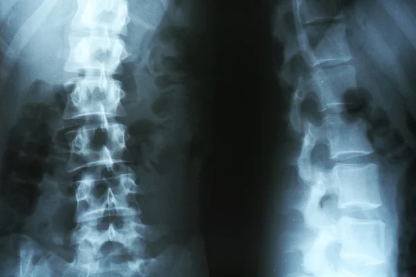 Raio Fechamento Coluna Vertebral Humana — Fotografia de Stock