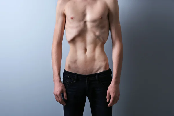 Hombre flaco con anorexia —  Fotos de Stock