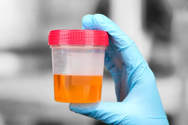 Test d'urine médicale — Photo