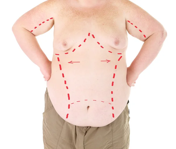 胖男人用上白色孤立的腹部整形手术行标记 — 图库照片