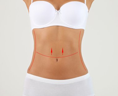 Plastik cerrahi. Liposuction. İnce gövde kavramı