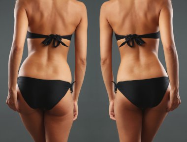 Plastik cerrahi. Liposuction. İnce gövde kavramı