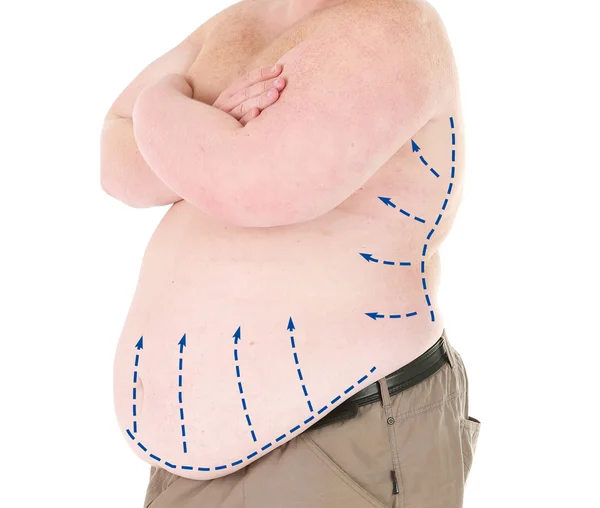 Hombre gordo marcado con líneas para cirugía estética abdominal aislado en blanco — Foto de Stock