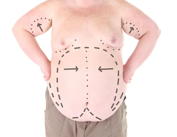 Fat man with lines for abdominal cosmetic surgery — Stockfoto