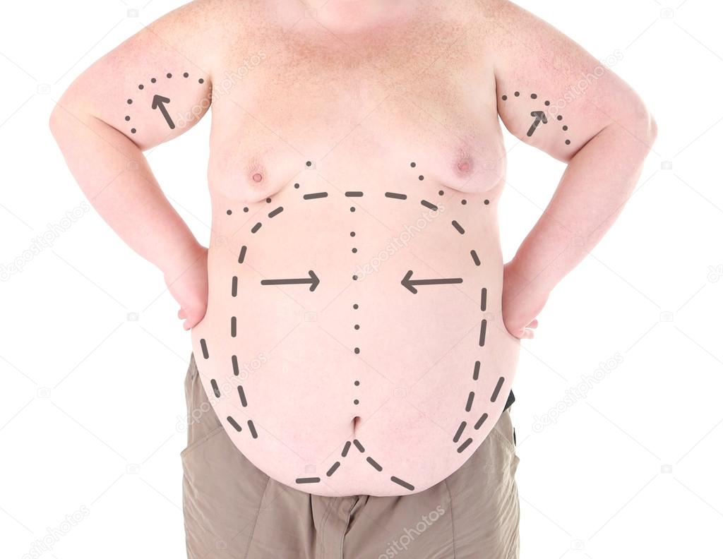 Fat man with lines for abdominal cosmetic surgery