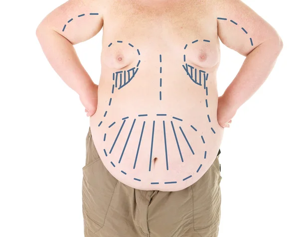 男人用腹部整形手术行标记 — 图库照片