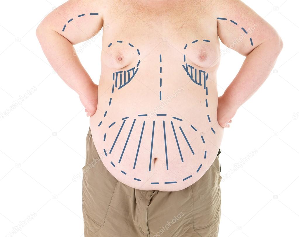 Man marked with lines for abdominal cosmetic surgery