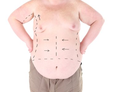 Şişman adam beyaz izole karın kozmetik cerrahi çizgilerle işaretlenmiş