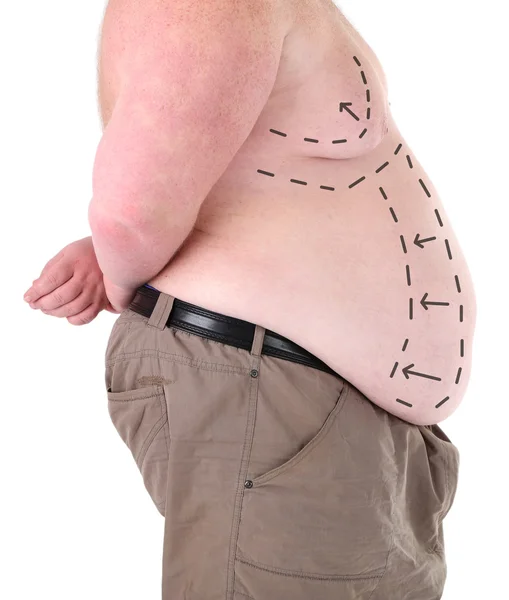 Fat man marked with lines — Stock Photo, Image