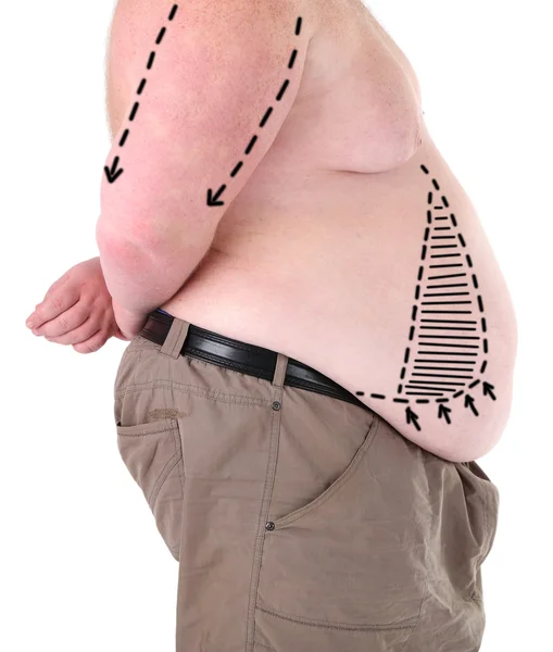 Tlustý muž s řádky pro kosmetické operaci břicha izolovaných na bílém — Stock fotografie
