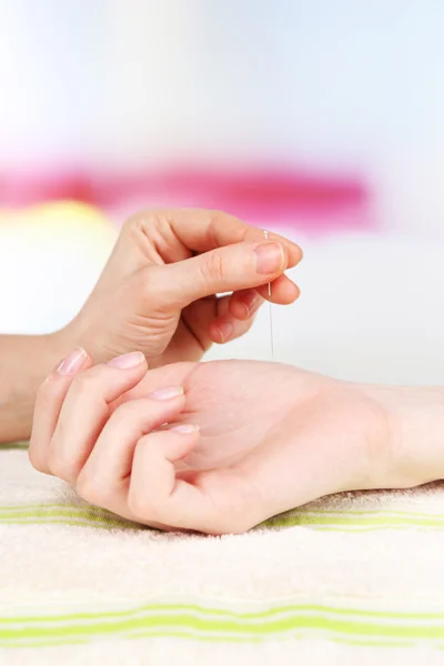 Akupunktur zur Hand — Stockfoto