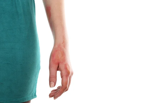 Φρικτό εγκαύματα στο γυναικείο χέρι που απομονώνονται σε λευκό — Φωτογραφία Αρχείου