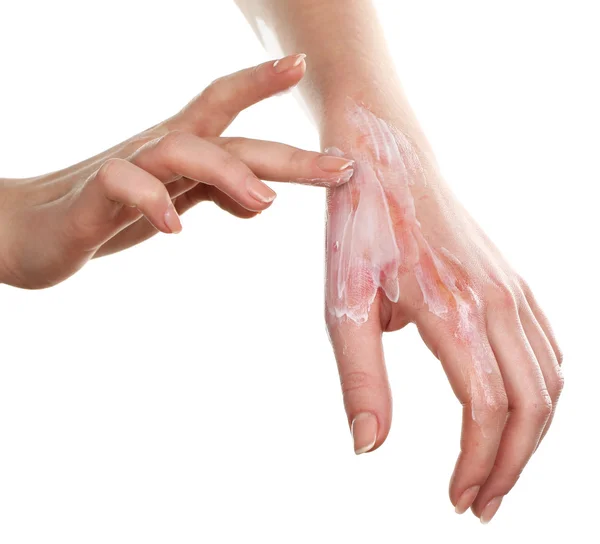 Tratamento de queimaduras na mão feminina isoladas em branco — Fotografia de Stock