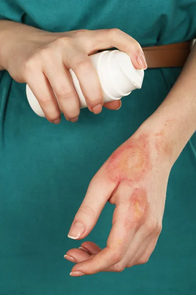 Treatment of burns by spray on female hand, closeup — Stock Photo, Image