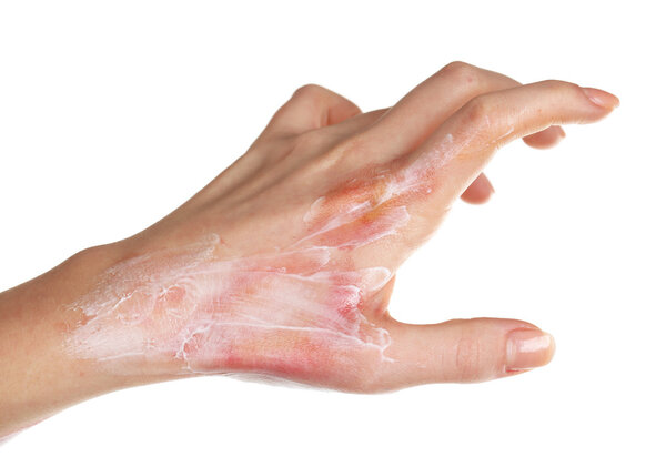 Лечение ожогов на женской руке, изолированных на белом
