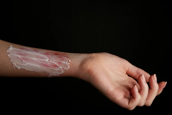 Treatment of burns on female hand on black background — Stock Photo, Image