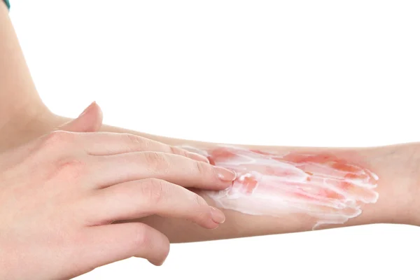 Tratamiento de quemaduras en la mano femenina aisladas en blanco —  Fotos de Stock