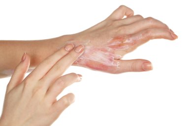 Beyaz izole el yanıkları tedavi