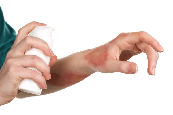 Treatment of burns by spray on female hand isolated on white — Stock Photo, Image