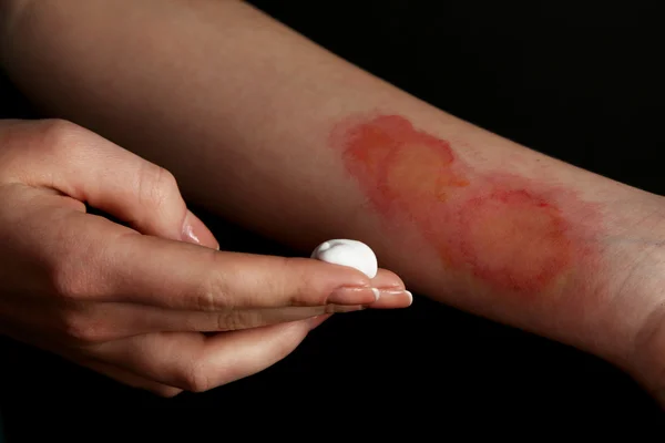 Traitement des brûlures sur la main féminine sur fond noir — Photo