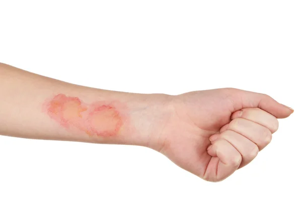 Burns on female hand — Stock Photo, Image