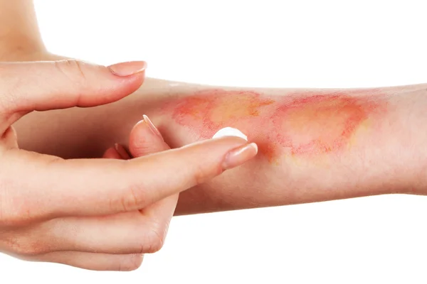 Treatment of burns — Stock Photo, Image