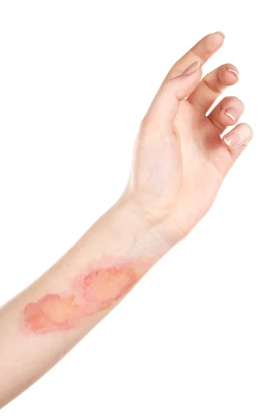 Horrible burns on female hand isolated on white — Stock Photo, Image