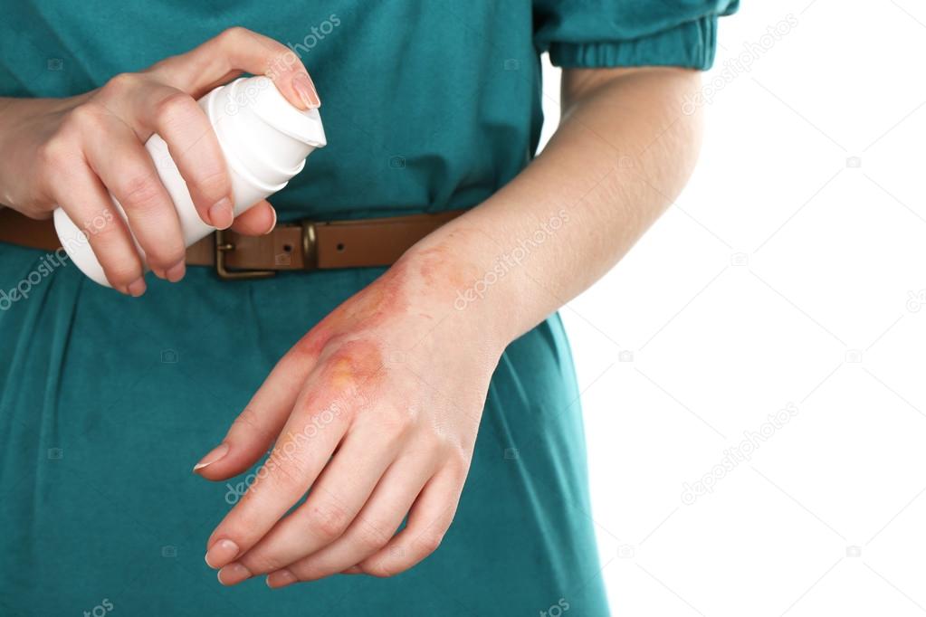Treatment of burns by spray on female hand isolated on white ⬇ Stock