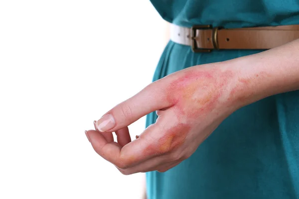Horribles quemaduras en la mano femenina — Foto de Stock