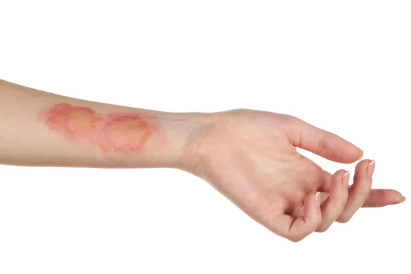 Horribles quemaduras en la mano femenina —  Fotos de Stock
