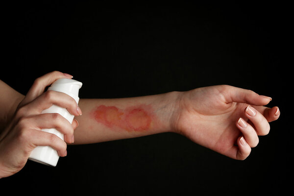 Лечение ожогов с помощью спрея
