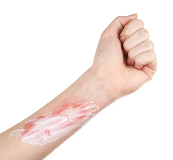 Treatment of burns on hand — Stock Photo, Image