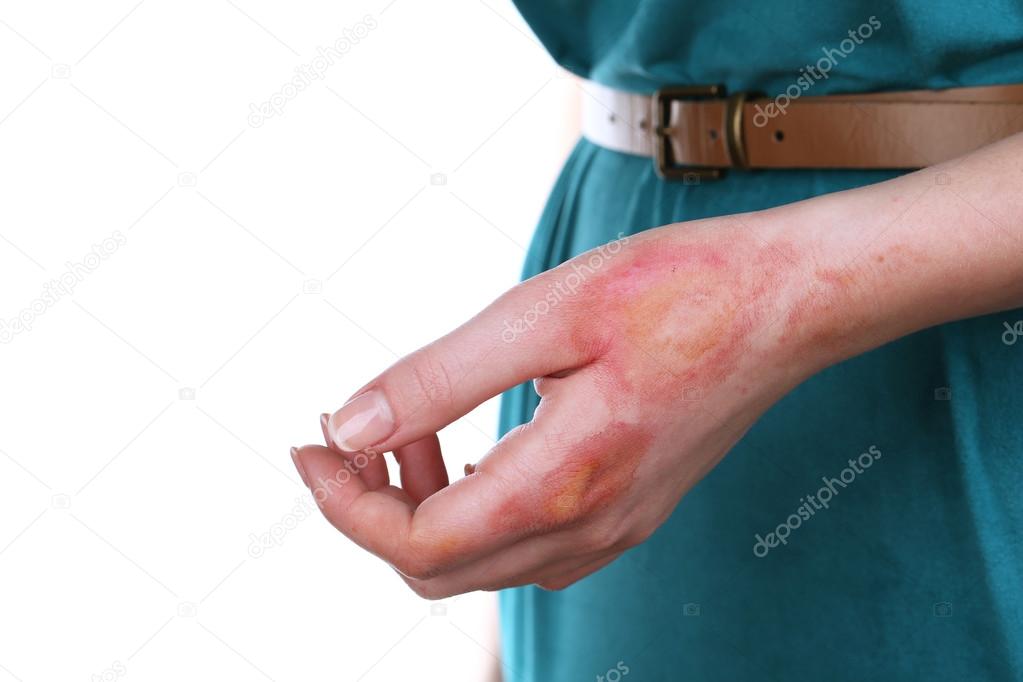 Horrible burns on female hand