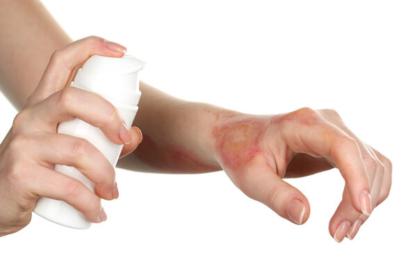 Лечение ожогов с помощью спрея на женской руке, изолированного на белом
