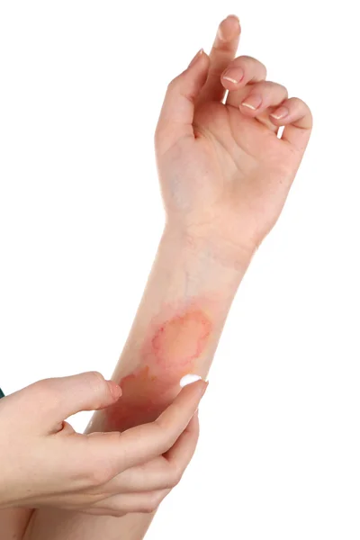 Treatment of burns on female hand, isolated on white — Stock Photo, Image