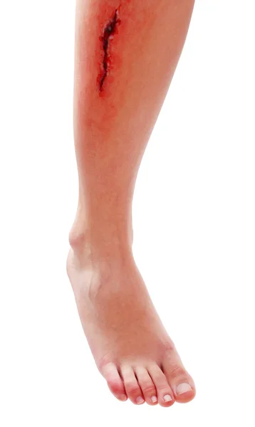 Injured leg with blood — Stock Photo, Image